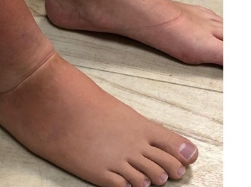 Gedeeltelijke cosmetische voetprothese