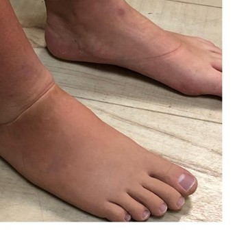 Prothèse partielle esthétique du pied